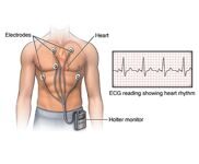 Суточное мониторирование ЭКГ по Холтеру