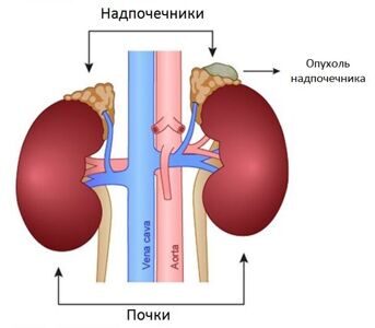 opuhol-nadpochechnikov