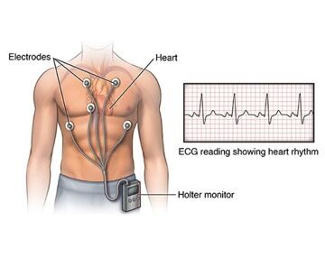 holter-monitor